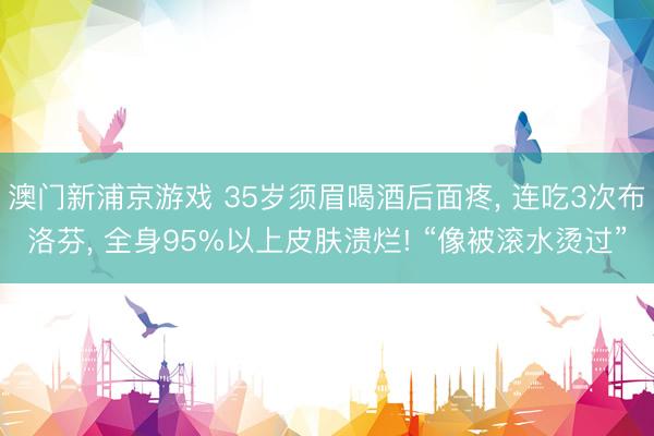 澳门新浦京游戏 35岁须眉喝酒后面疼， 连吃3次布洛芬， 全身95%以上皮肤溃烂! “像被滚水烫过”